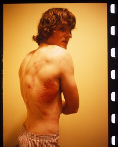 Van-Homan-bruised-ribs